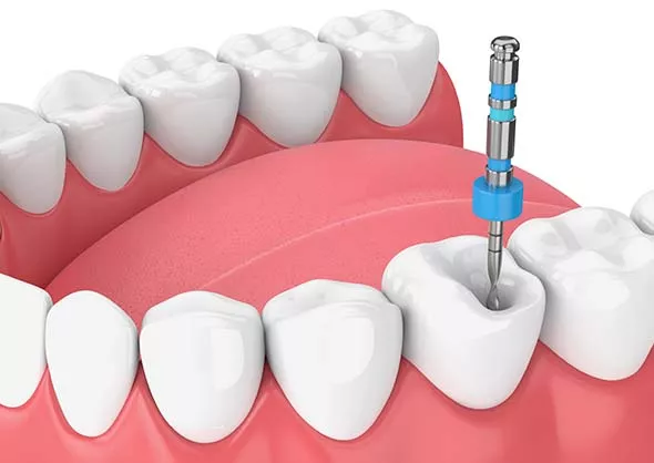 endo-canal-2