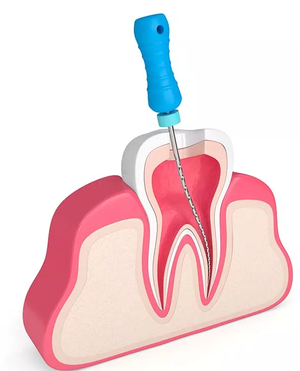 endo-canal-3