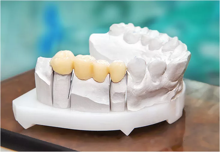 Model of a dental bridge